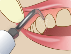 歯周病の基本治療