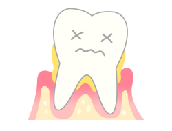 重度の歯周病の歯のイメージ